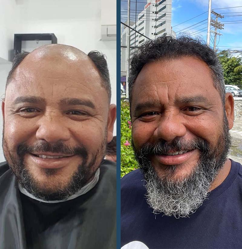 Antes e depois de transplante capilar