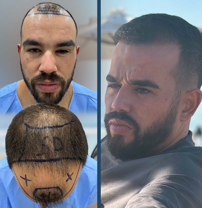 Antes e depois de transplante capilar