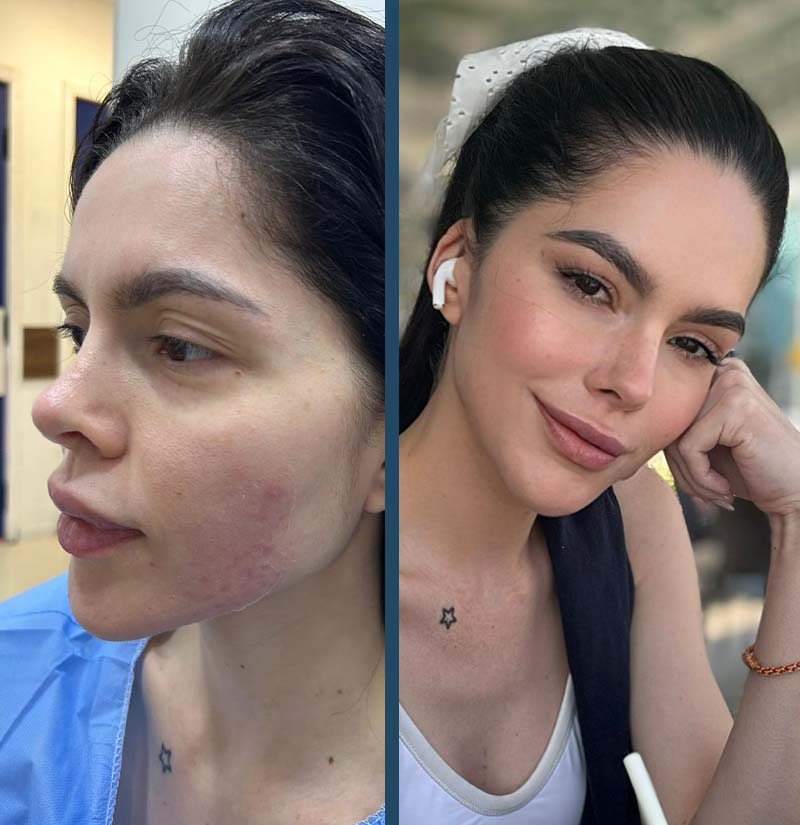 Antes e depois de transplante capilar