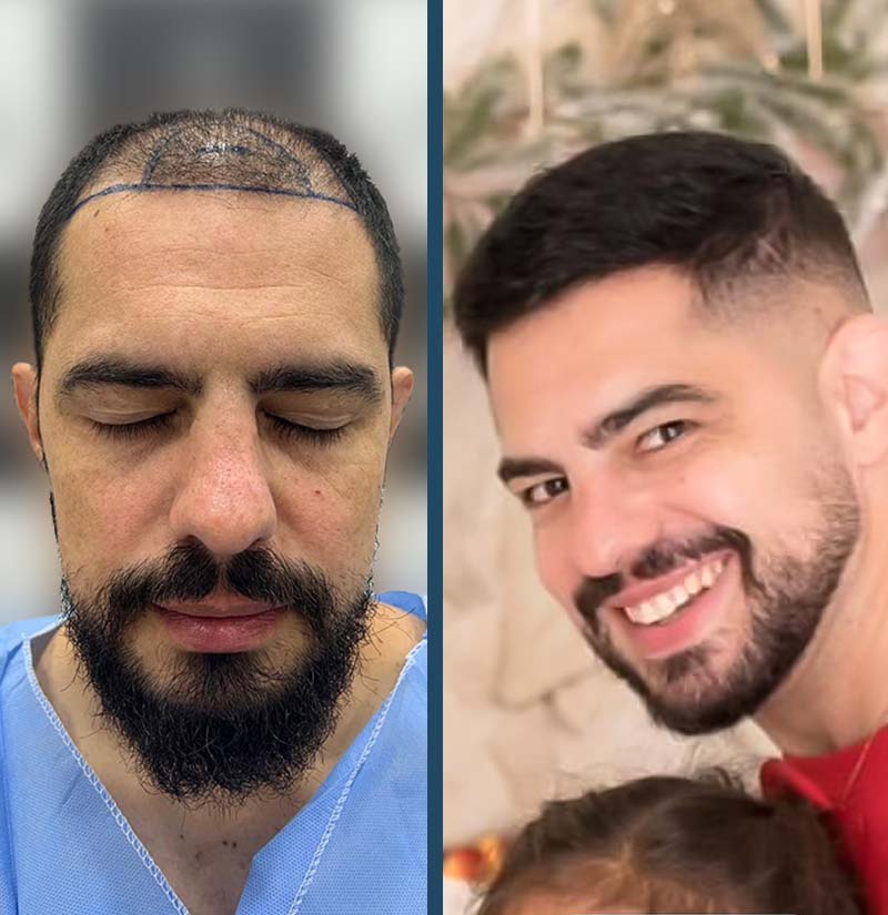 Antes e depois de transplante capilar
