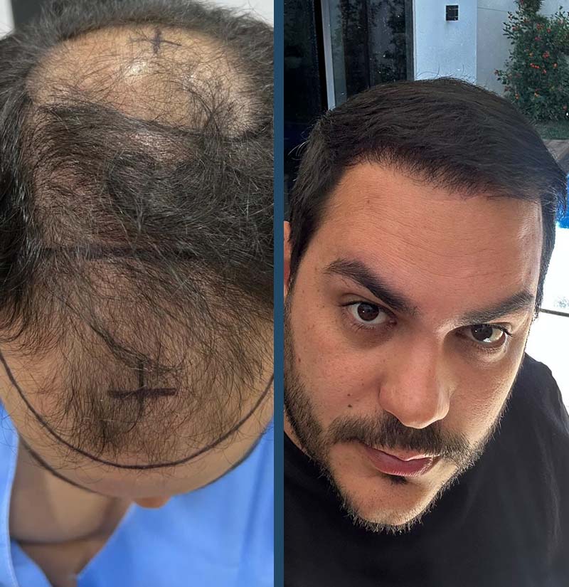 Antes e depois de transplante capilar