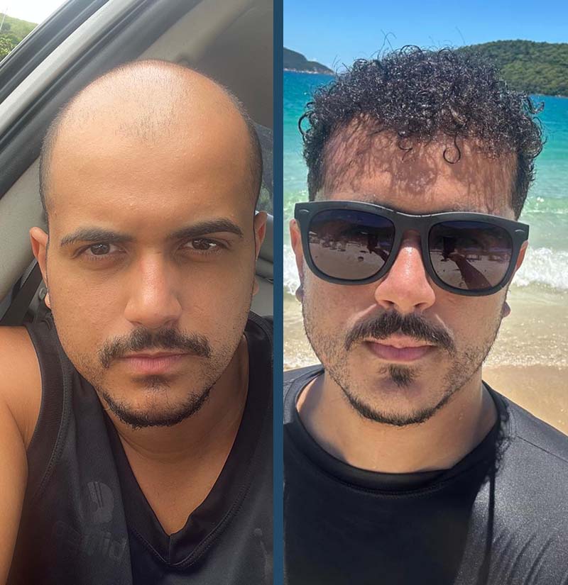 Antes e depois de transplante capilar